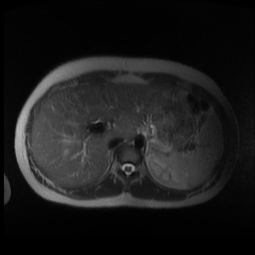 Normal MRI abdomen in pregnancy (Radiopaedia 88003-104546 Axial T2 1).jpg