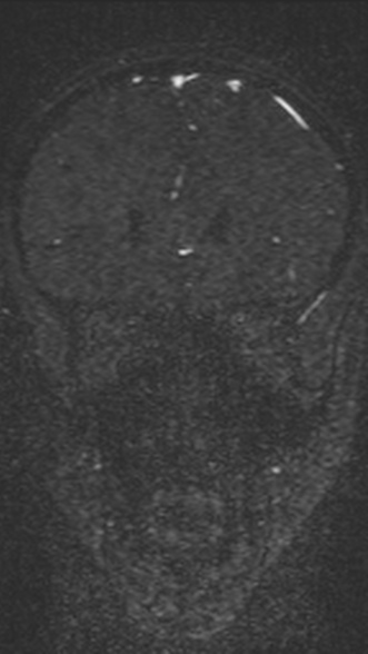 Normal MRI brain with MRV- teenager (Radiopaedia 49425-54553 Coronal MRV 85).jpg