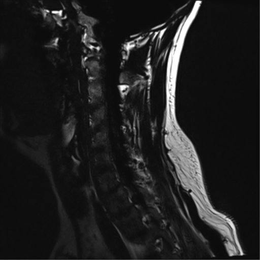 File:Normal MRI cervical spine (infection protocol) (Radiopaedia 53916-60039 F 6).png