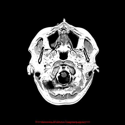 Normal adult brain MRI (non-enhanced and contrast-enhanced) (Radiopaedia 75262-86379 Axial T1 C+ 40).jpg