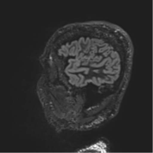 Normal brain MRI (non-focal epilepsy protocol) (Radiopaedia 53917-60040 Sagittal DIR 13).png