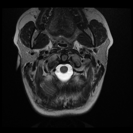 File:Normal cervical and thoracic spine MRI (Radiopaedia 35630-37156 Axial T2 31).png