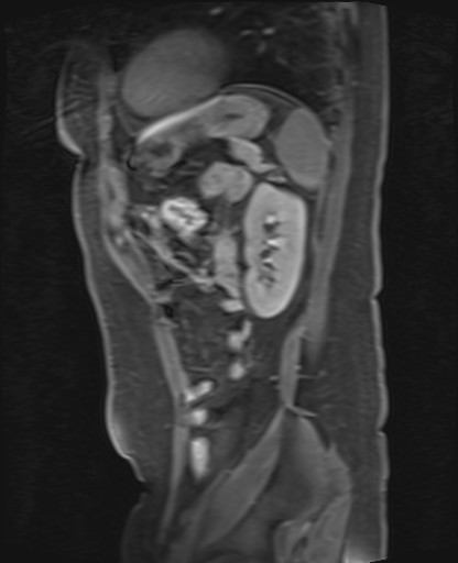 File:Normal hepatobiliary phase liver MRI (Radiopaedia 58968-66230 C 59).jpg