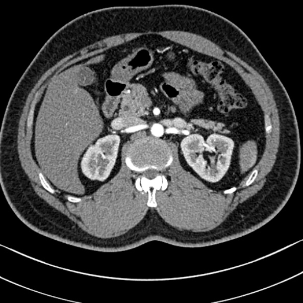 Normal kidneys on 4-phase CT study (Radiopaedia 25889-26038 B 25).jpg