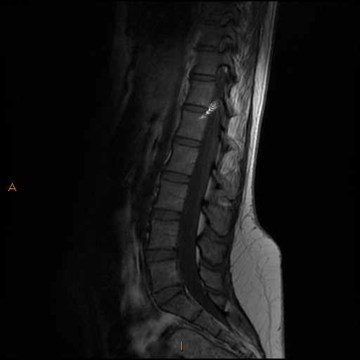 File:Normal spine MRI (Radiopaedia 77323-89408 Sagittal T1 8).jpg