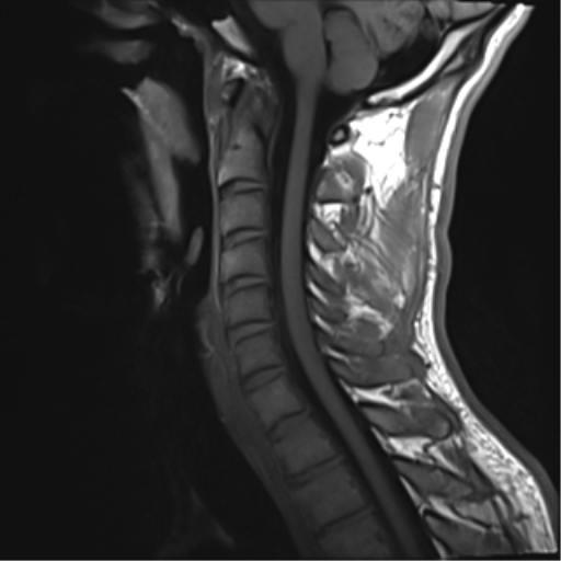 File:Normal trauma cervical spine (Radiopaedia 41017-43762 Sagittal T1 9).png