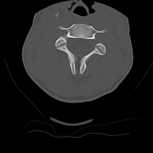 File:Normal trauma spine imaging (age 16) (Radiopaedia 45335-49358 Axial bone window 27).jpg