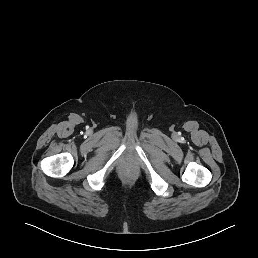Obstructing sigmoid adenocarcinoma (Radiopaedia 58465-65619 A 172).jpg