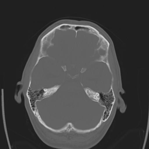 File:Obstructive hydrocephalus (Radiopaedia 30453-31119 Axial bone window 23).jpg