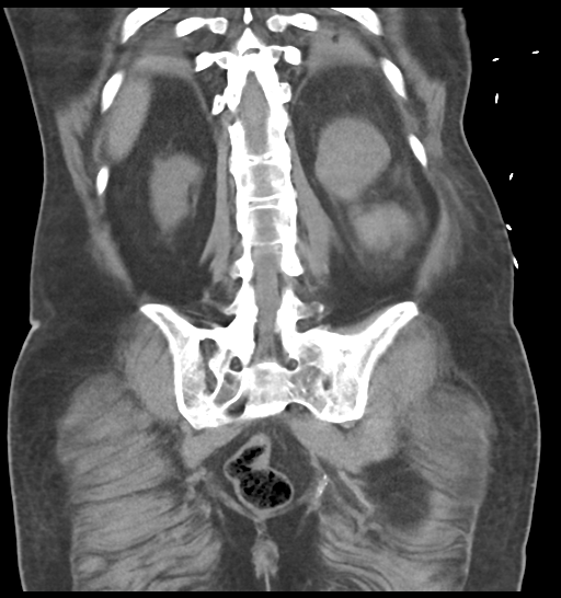 File:Obstructive pyelonephritis (Radiopaedia 46411-50844 Coronal non-contrast 49).png