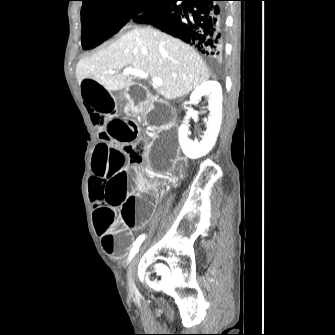 Obturator hernia causing small bowel obstruction (Radiopaedia 65522-74612 C 69).jpg