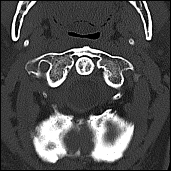 Occipital condyle fracture (type 1) (Radiopaedia 87670-104084 Axial bone window 17).jpg