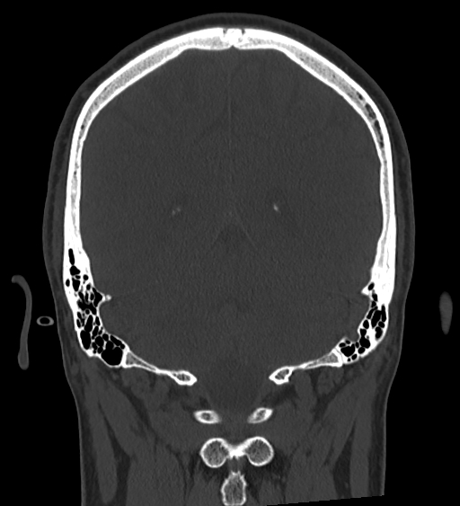 Occipital spur and Currarino type A atlas anomaly (Radiopaedia 87027-103285 Coronal bone window 105).jpg