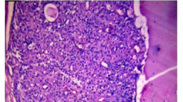 Nodular hidradenoma, showing clear and polygonal cells with foci of eosinophilic material
