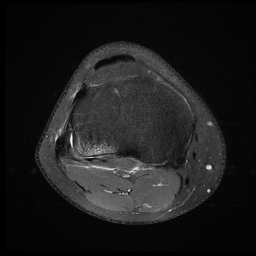 File:ACL acute full thickness tear - deep lateral femoral sulcus sign (Radiopaedia 38594-40740 Axial PD fat sat 19).jpg