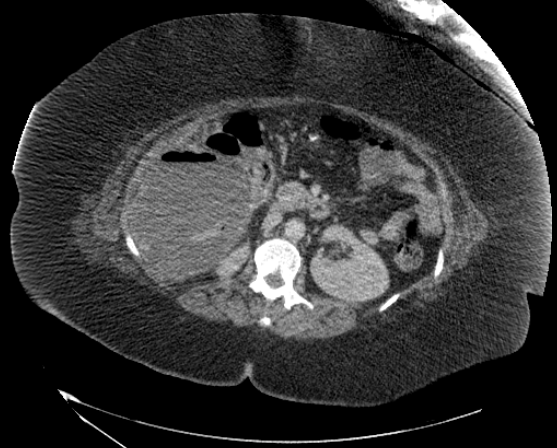 File:Abdominal abscess - pre and post percutaneous drainage (Radiopaedia 60209-67816 Axial 25).png