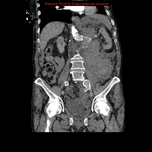 Abdominal aortic aneurysm- extremely large, ruptured (Radiopaedia 19882-19921 Coronal C+ arterial phase 58).jpg