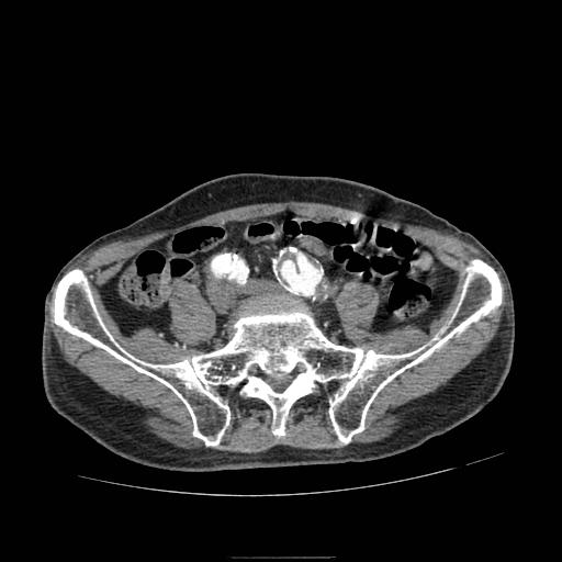Abdominal aortic aneurysm (Radiopaedia 13341-13340 Axial C+ arterial phase 170).jpg
