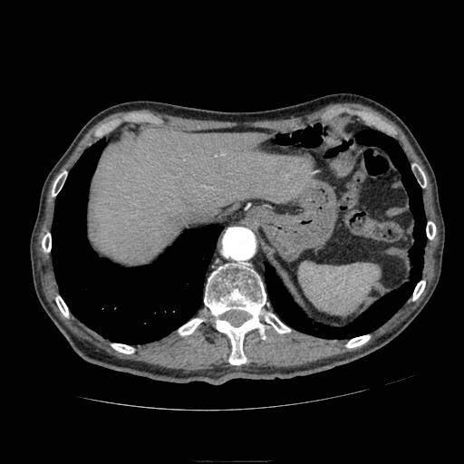 Abdominal aortic aneurysm (Radiopaedia 13341-13340 Axial C+ arterial phase 24).jpg