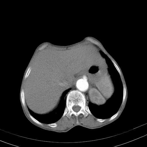 File:Abdominal aortic aneurysm (Radiopaedia 20827-20742 Axial C+ arterial phase 6).jpg