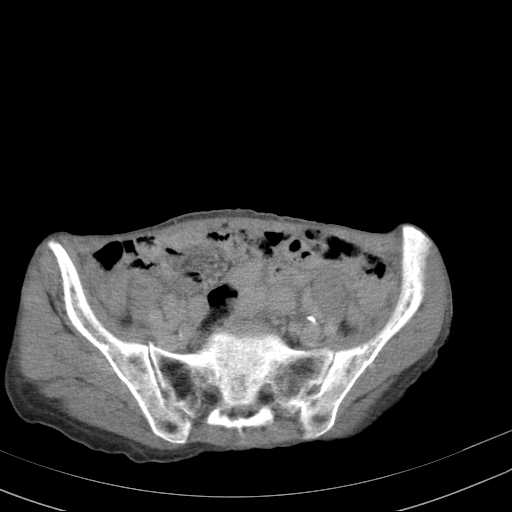 File:Abdominal aortic aneurysm (Radiopaedia 20827-20742 Axial C+ delayed 26).jpg