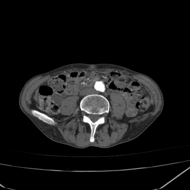 Abdominal aortic aneurysm (Radiopaedia 23703-23856 Axial C+ arterial phase 55).jpg