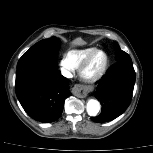 Abdominal aortic aneurysm (Radiopaedia 29248-29660 Axial C+ arterial phase 3).jpg