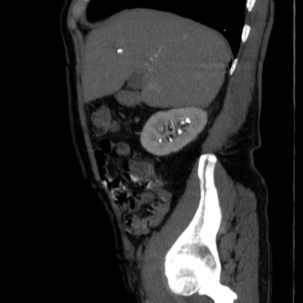 Abdominal aortic aneurysm (Radiopaedia 29248-29660 Sagittal C+ arterial phase 13).jpg
