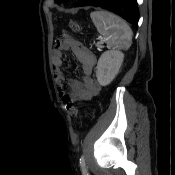 Abdominal aortic aneurysm (Radiopaedia 29248-29660 Sagittal C+ arterial phase 44).jpg