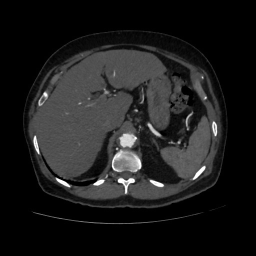 File:Abdominal aortic aneurysm (Radiopaedia 57318-64259 Axial C+ arterial phase 17).jpg