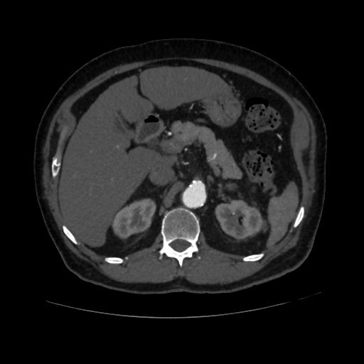 File:Abdominal aortic aneurysm (Radiopaedia 57318-64259 Axial C+ arterial phase 22).jpg
