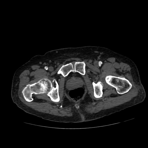 File:Abdominal aortic aneurysm (Radiopaedia 57318-64259 Axial C+ arterial phase 76).jpg