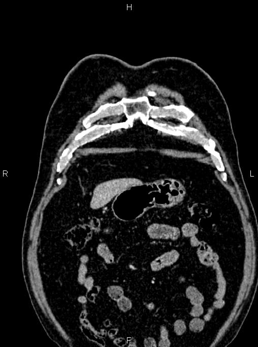 Abdominal aortic aneurysm (Radiopaedia 83094-97462 Coronal renal cortical phase 19).jpg