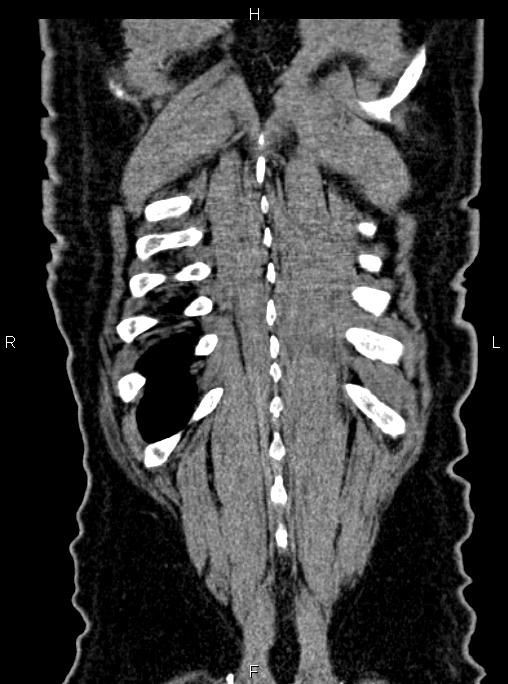 Abdominal aortic aneurysm (Radiopaedia 83094-97462 Coronal renal cortical phase 85).jpg
