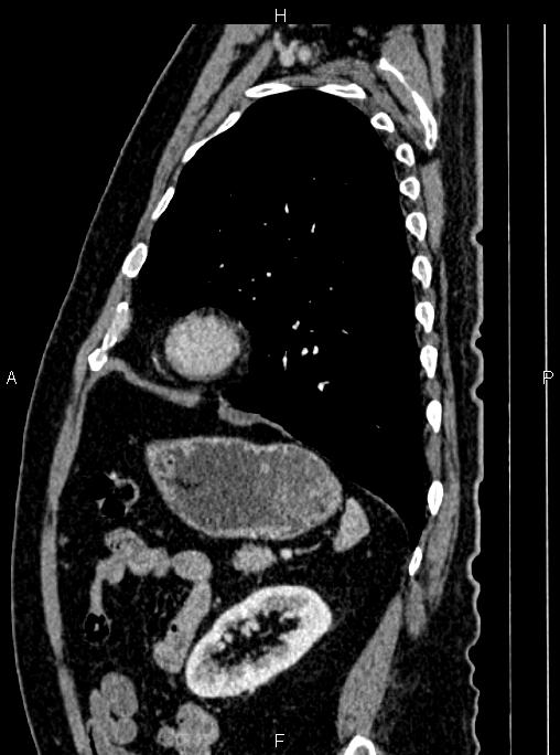 Abdominal aortic aneurysm (Radiopaedia 83094-97462 Sagittal renal cortical phase 92).jpg