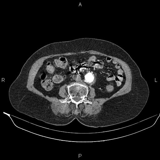 File:Abdominal aortic aneurysm (Radiopaedia 85063-100606 Axial C+ arterial phase 43).jpg