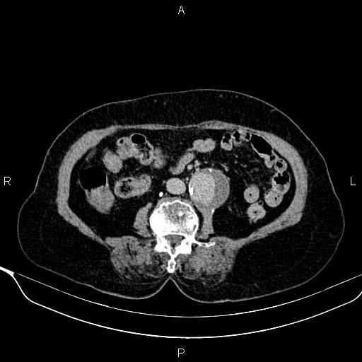 Abdominal aortic aneurysm (Radiopaedia 85063-100606 Axial C+ delayed 61).jpg