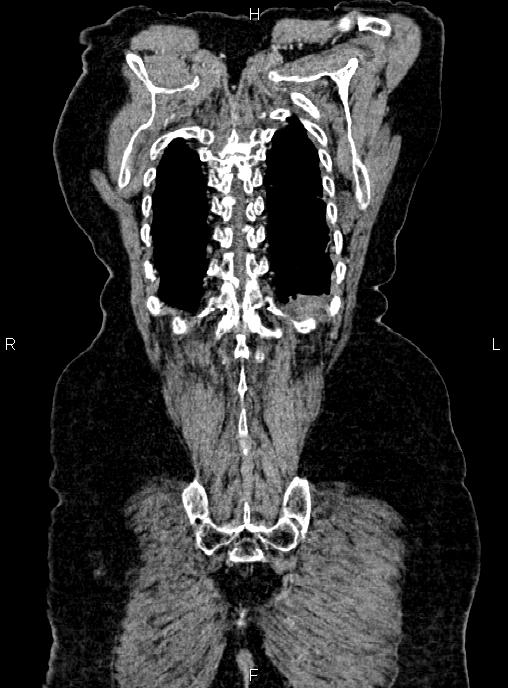 Abdominal aortic aneurysm (Radiopaedia 85063-100606 Coronal C+ arterial phase 55).jpg