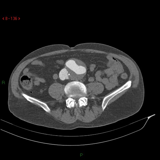 Abdominal aortic aneurysm rupture with aortocaval fistula (Radiopaedia 14897-14841 Axial C+ arterial phase 136).jpg