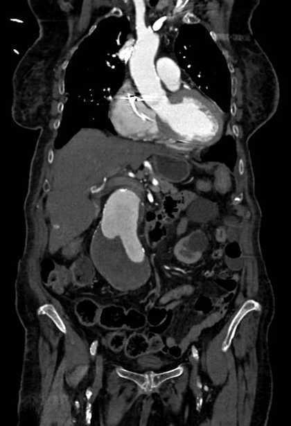 Abdominal aortic aneurysm with thrombus fissuration (Radiopaedia 73192-83919 Coronal C+ arterial phase 25).jpg