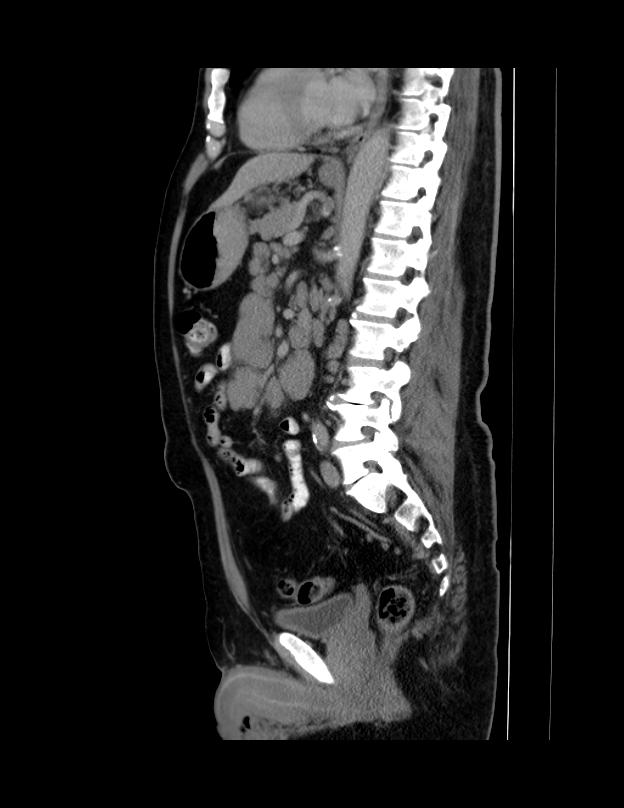 Abdominal lymphoma - with sandwich sign (Radiopaedia 53486-59492 Sagittal C+ portal venous phase 35).jpg