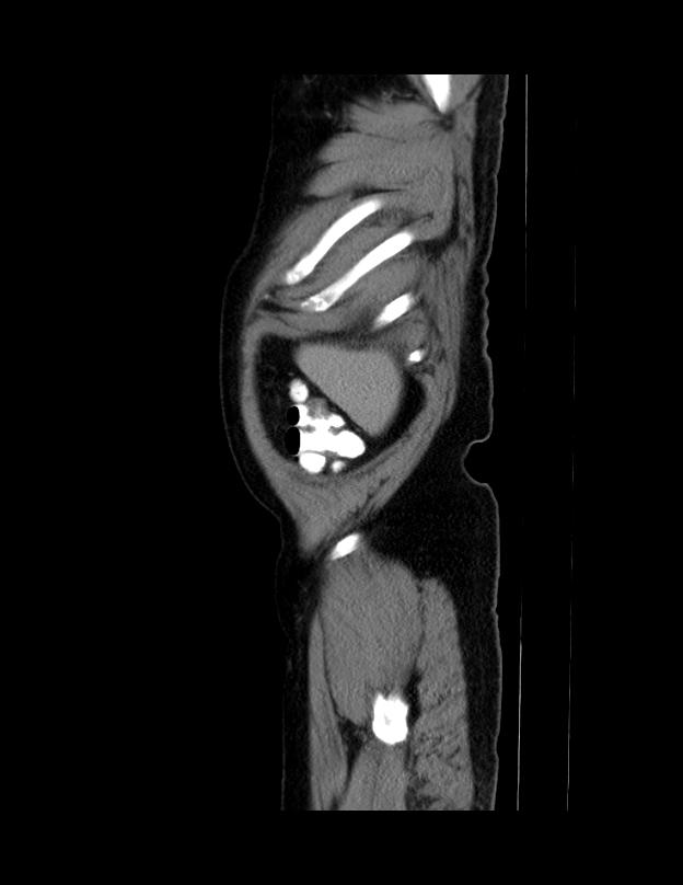 Abdominal lymphoma - with sandwich sign (Radiopaedia 53486-59492 Sagittal C+ portal venous phase 75).jpg