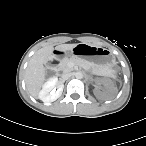 File:Abdominal multi-trauma - devascularised kidney and liver, spleen and pancreatic lacerations (Radiopaedia 34984-36486 Axial C+ delayed 26).png
