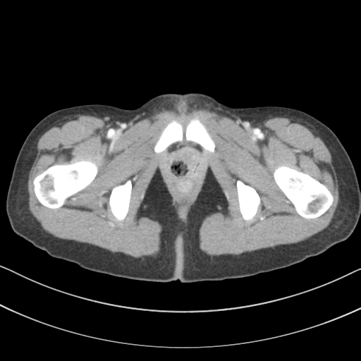 File:Abdominal multi-trauma - devascularised kidney and liver, spleen and pancreatic lacerations (Radiopaedia 34984-36486 Axial C+ portal venous phase 85).png
