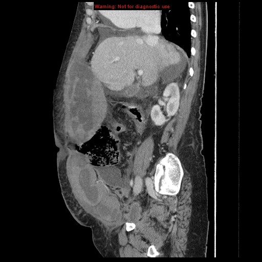 Abdominal wall hematoma (Radiopaedia 9427-10112 Sagittal C+ portal venous phase 69).jpg