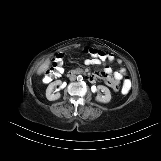 File:Abdominal wall recurrence after colorectal resection for cancer (Radiopaedia 23444-23523 Axial C+ portal venous phase 13).jpg