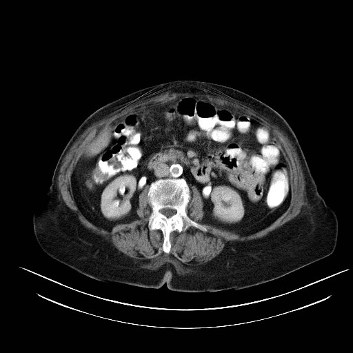 File:Abdominal wall recurrence after colorectal resection for cancer (Radiopaedia 23444-23523 Axial C+ portal venous phase 14).jpg