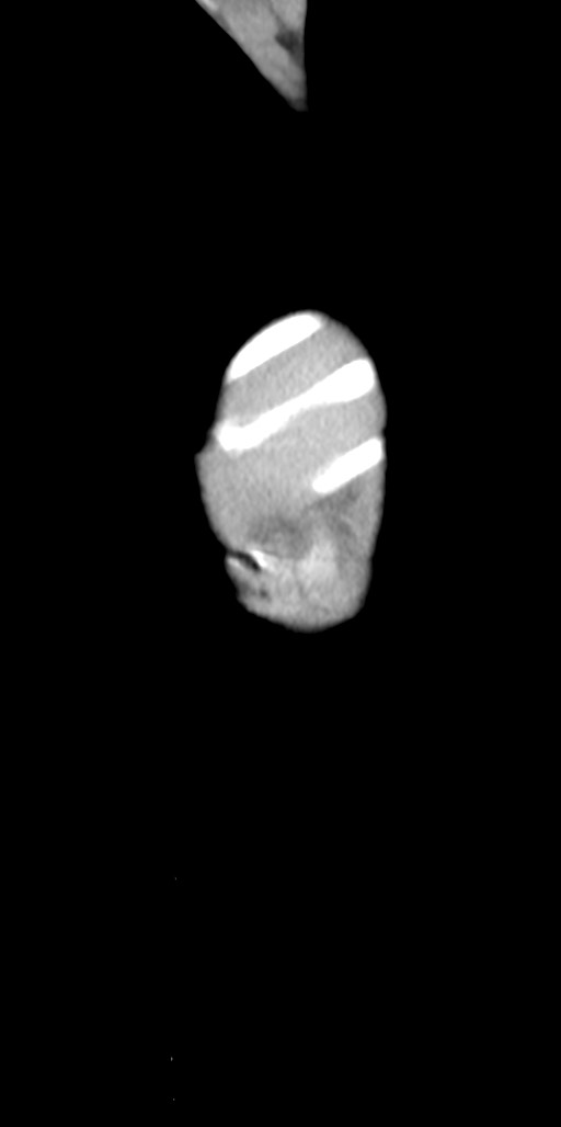 Abdominopelvic rhabdomyosarcoma (Radiopaedia 78356-90984 Sagittal C+ portal venous phase 7).jpg
