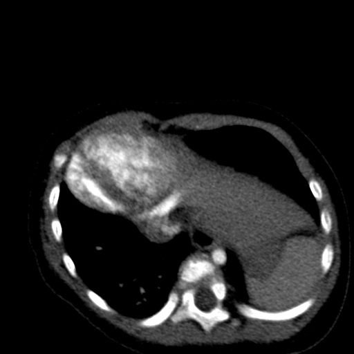 Aberrant left pulmonary artery (pulmonary sling) (Radiopaedia 42323-45435 Axial C+ CTPA 35).jpg