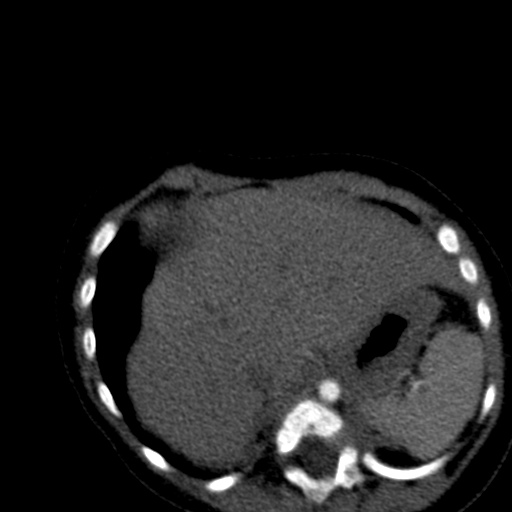 File:Aberrant left pulmonary artery (pulmonary sling) (Radiopaedia 42323-45435 Axial C+ CTPA 42).jpg